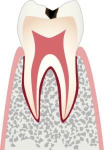 C1 エナメル質に小さな穴が空いたむし歯