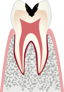 C2 歯の内部（象牙質）まで進行したむし歯