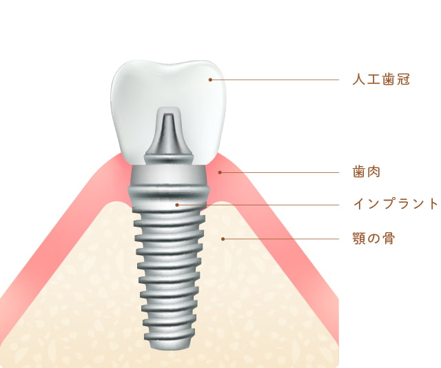 インプラントの構造のイラスト