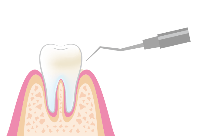 スケーリング（歯石取り）