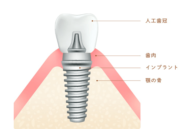 インプラントの構造と素材