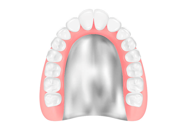 コバルトクロム床義歯