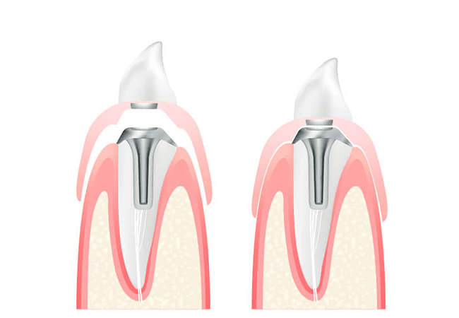 マグネットデンチャー