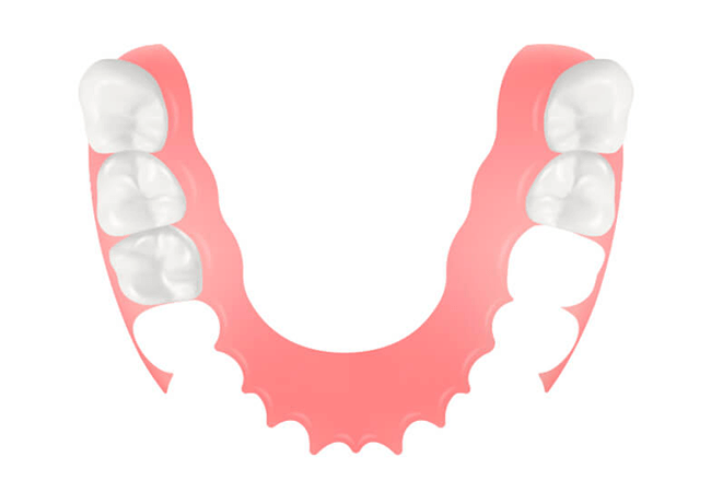 ノンクラスプデンチャー