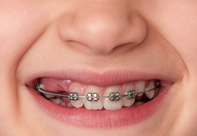 ブラケット矯正