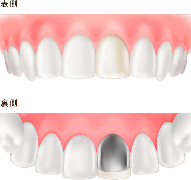 コンポジットレジン