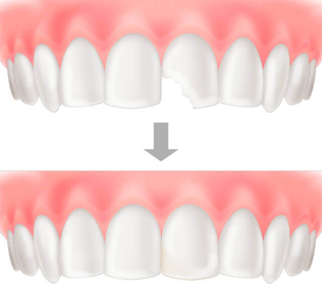 ダイレクトボンディング