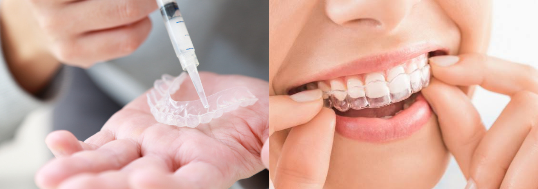 ホワイトニングの種類