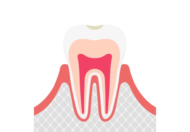 【CO】ごく初期のむし歯