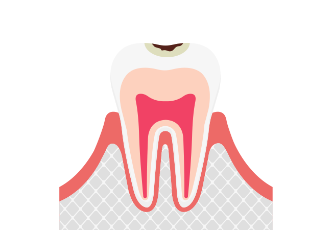 【C1】エナメル質に小さな穴が空いたむし歯