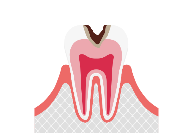 【C2】歯の内部（象牙質）まで進行したむし歯