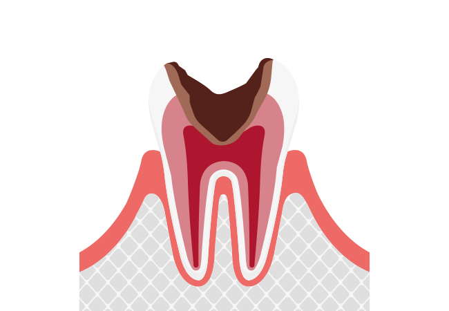 【C3】神経まで進行したむし歯
