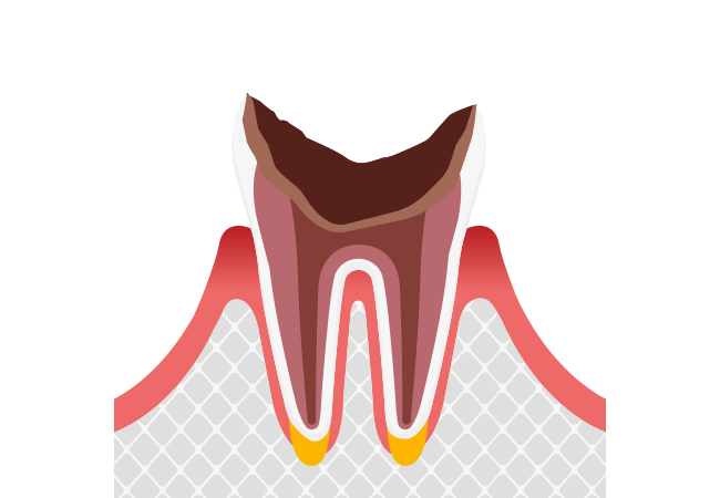 【C4】歯根まで進行したむし歯